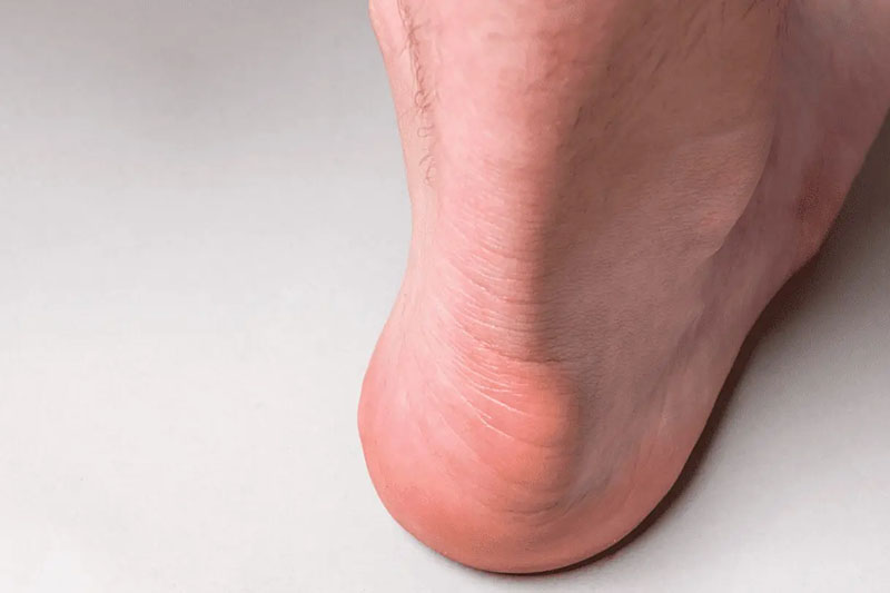 Haglundova peta poškodba